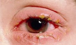 Göz Taşı Hastalığı Nedir Belirtileri Nelerdir