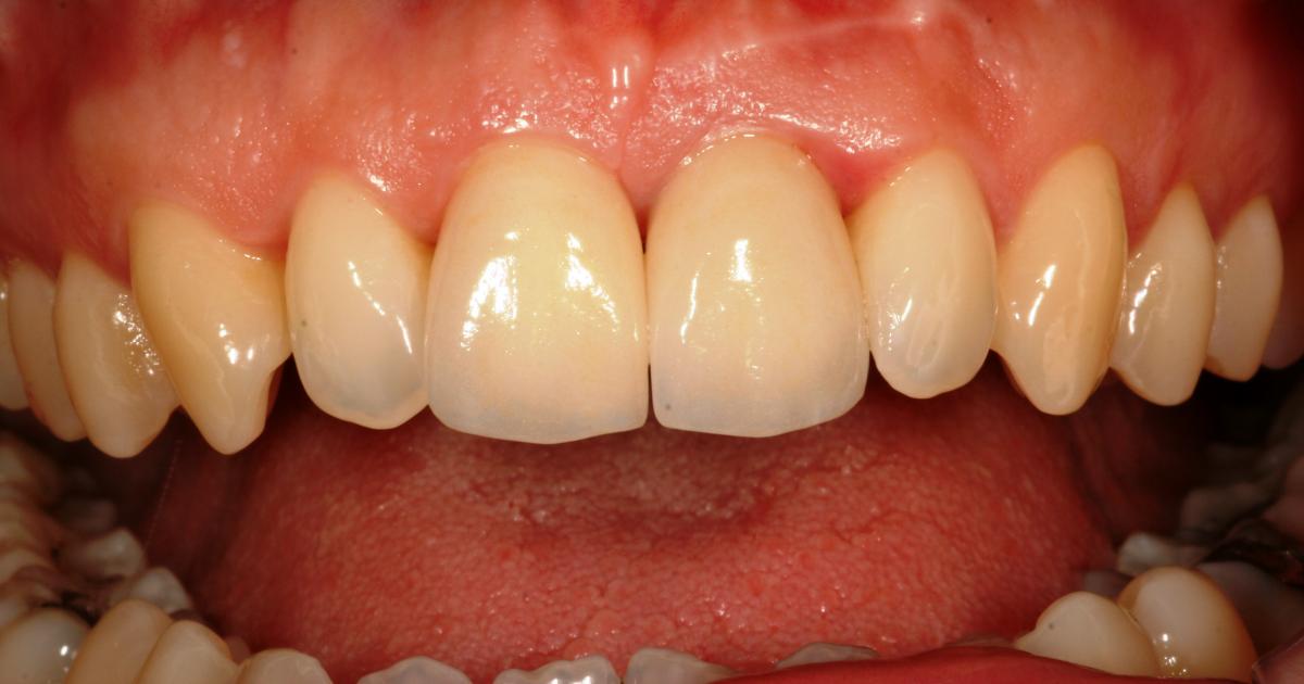 Diş Sararması Neden Olur,Nasıl Önlenir İlaç Çeşitleri