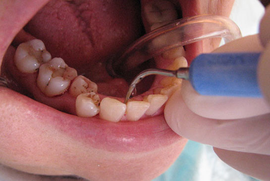 Dişlerdeki Siyah Lekeler Nasıl Geçer