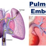 Akciğer Embolisi, Akciğer İnfarktı Belirtileri ve Tedavisi